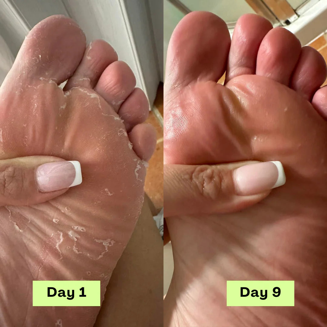 Nurelya® AntiFungal Relief Soap Bar